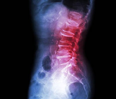 Failed back surgery syndrome